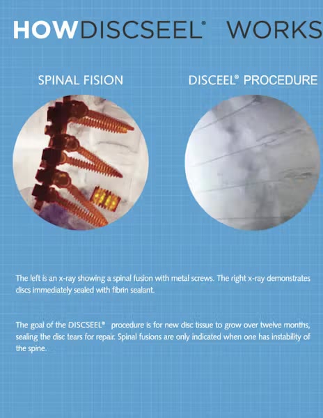 Discseel Procedure does not require fusion. Outpatient. Same-day walking.