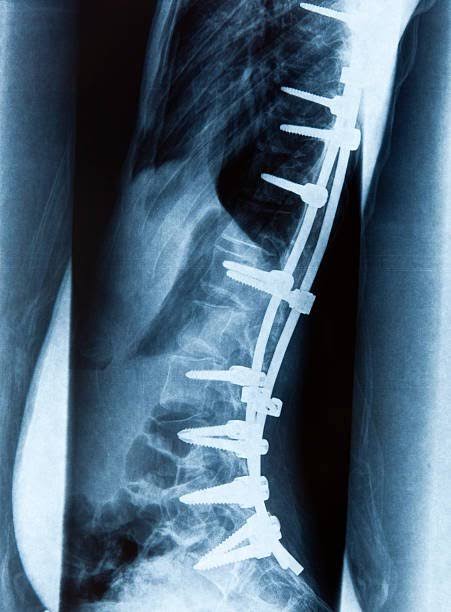 Side X-ray of multilevel spinal fusion from thoracic through lumbar spine with rods and screws. Discseel Procedure has no metal implants.