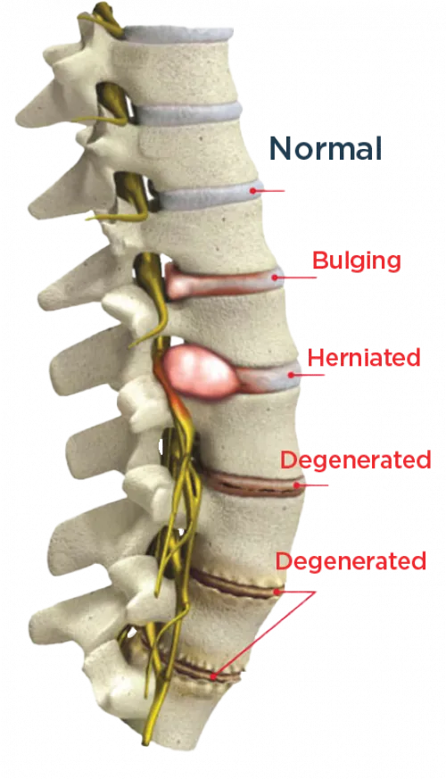 Spinal discs: normal, bulging, herniated, and degenerated. Discseel Procedure education.