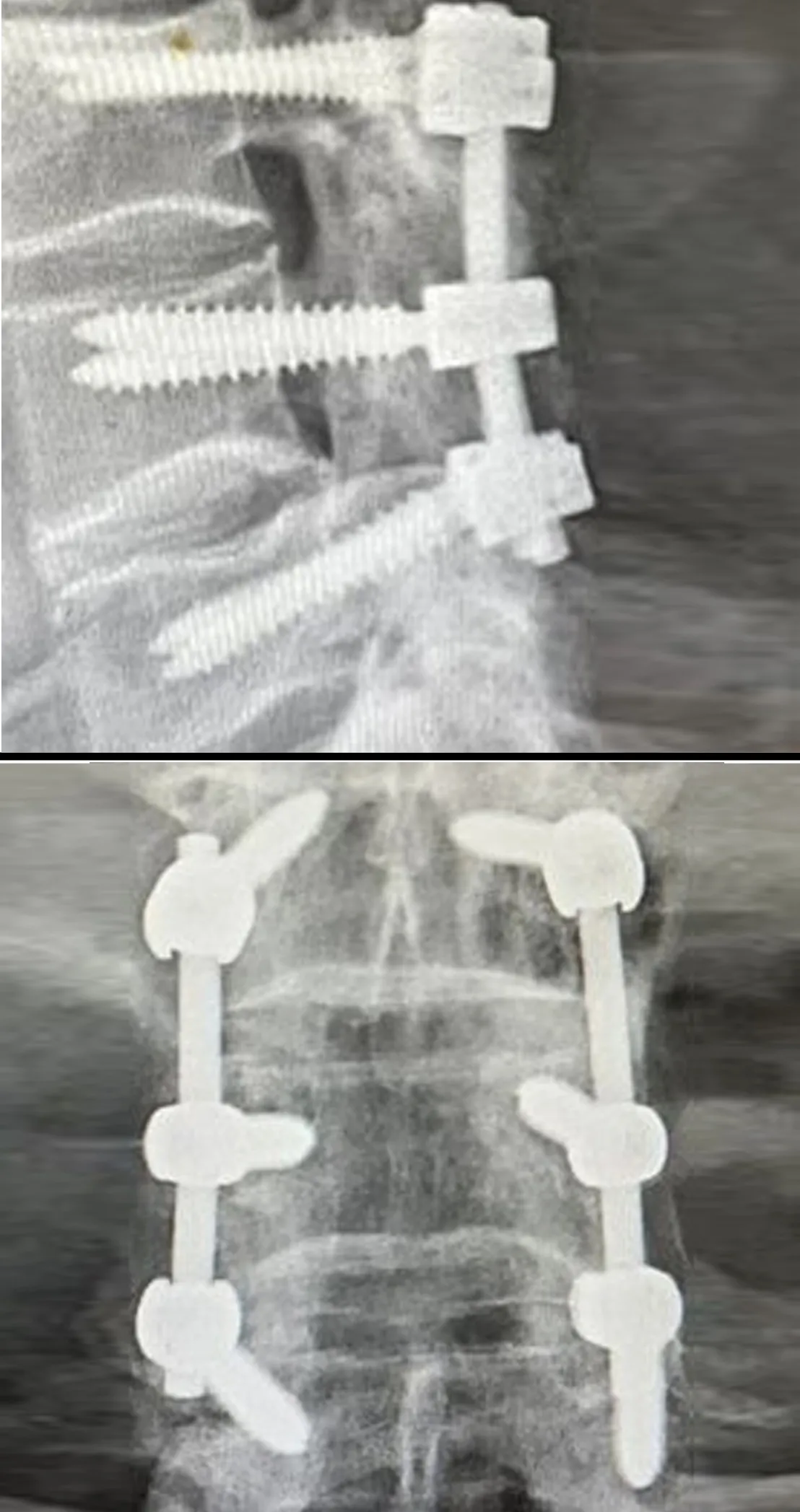 Side and front X-rays of spinal fusion with pedicle screws and rods. Discseel Procedure leaves no implants.