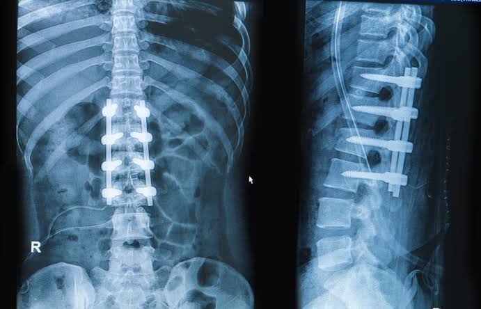 Front and side X-rays of lumbar spinal fusion with rods and pedicle screws. Discseel Procedure uses no metal implants.